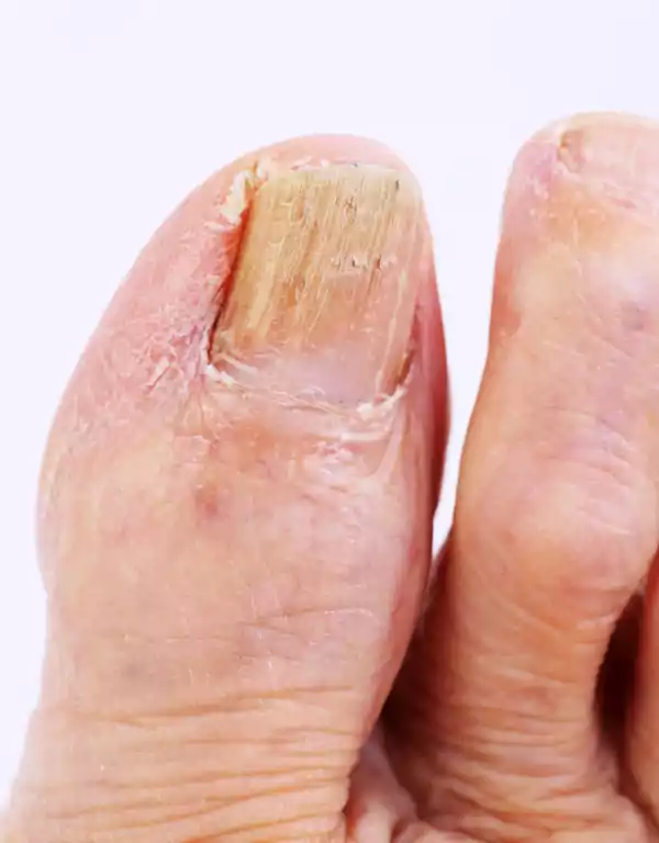 FootTherapy Ονυχομυκητίαση