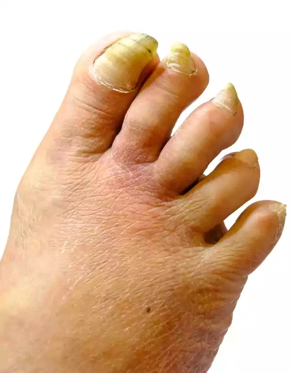 FootTherapy, Ονυχογρύπωση